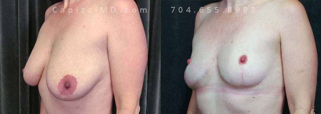This patient had a breast reduction in the past but was noticing that over the years with child-bearing, they had become large and saggy. A revision breast reduction left her with small breasts (per her desire) and perky nipples.