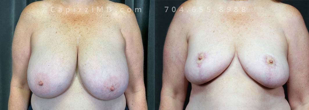 This patient had large breasts that were giving her daily pain in her neck and back. She wanted to realign her nipples, improve symmetry and reduce the size of her breasts.