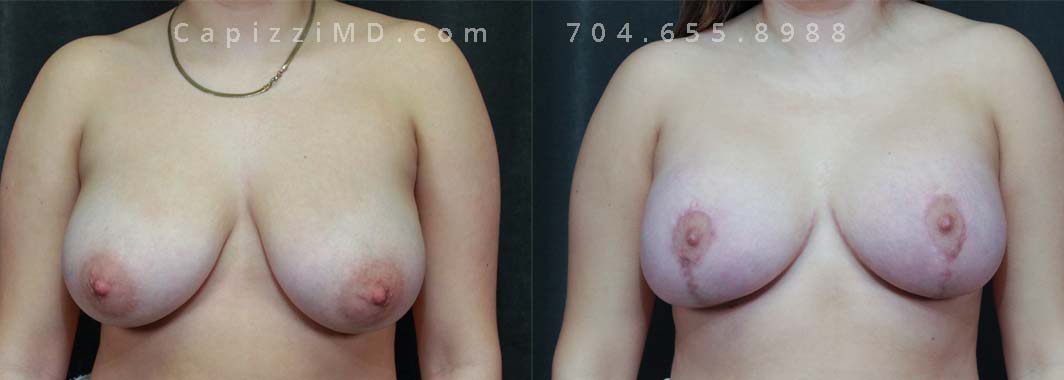 This patient had large, sagging breasts that she wished to reduce. She is pictured only one month after her breast reduction, hence a pinker scar. Any surgical incisions are pink for the first 12 months, before fading into the skin tone of the patient.