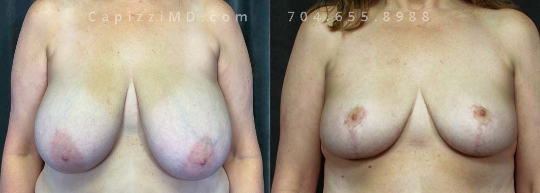This patient's large breasts were giving her issues in her daily life and she wanted them smaller to better accommodate her day-to-day. A breast reduction realigned her nipples, resized her areolas, and gave her the result she was hoping for.