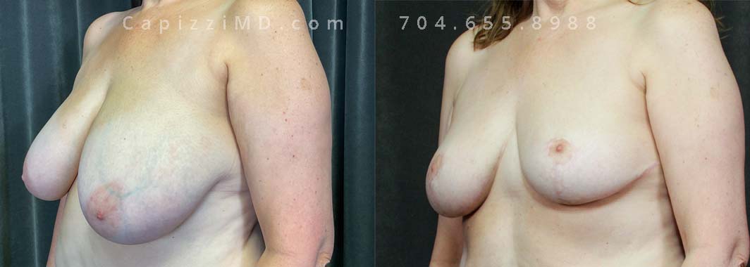 This patient's large breasts were giving her issues in her daily life and she wanted them smaller to better accommodate her day-to-day. A breast reduction realigned her nipples, resized her areolas, and gave her the result she was hoping for.