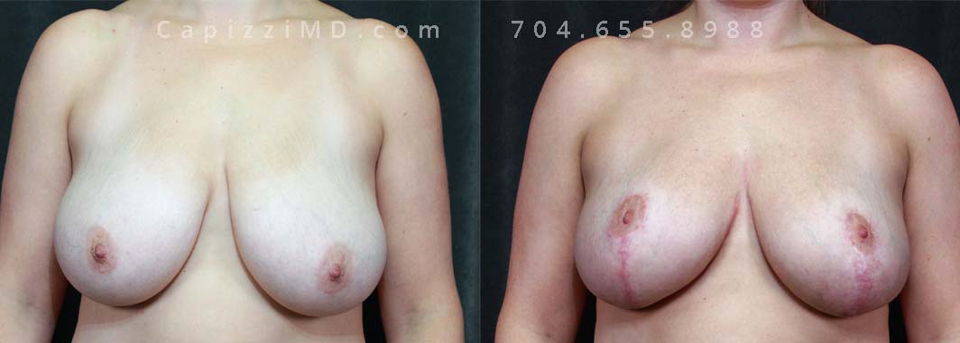 The patient had children and noticed that her breasts stayed large after she discontinued nursing. A breast reduction reduced the size of her breasts, removed excess skin, and realigned her nipples.
