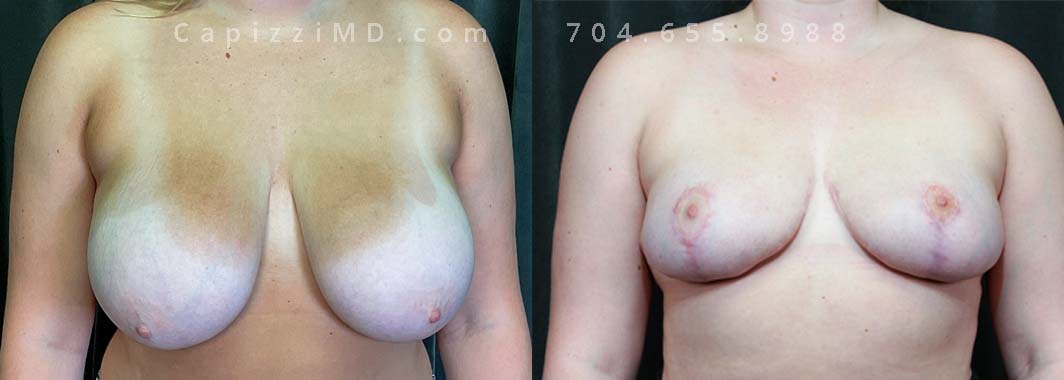This patient was experiencing grooving from her bra straps and back pain from heavy breasts. She wanted breasts that were smaller and more proportional to her frame. Liposuction to her bra roll ensured that she had a nice contour around her back.