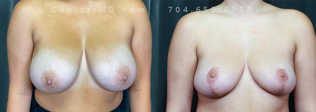 This patient had larger breasts than desired and wanted to have a smaller, more perky look. A breast reduction alleviated physical symptoms such as back/neck pain while also giving her a naturally smaller breast shape.