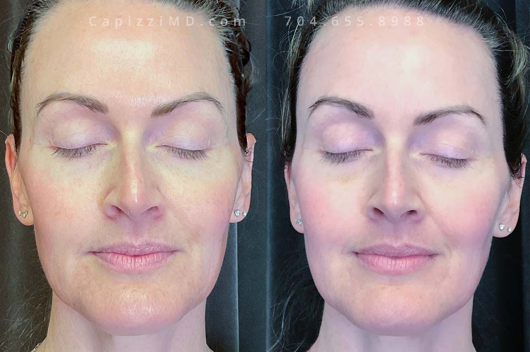 This patient was experiencing melasma that was centered in her lower cheeks, a Cosmelan Peel removed fine lines from her face as well as the hyperpigmentation globally.
