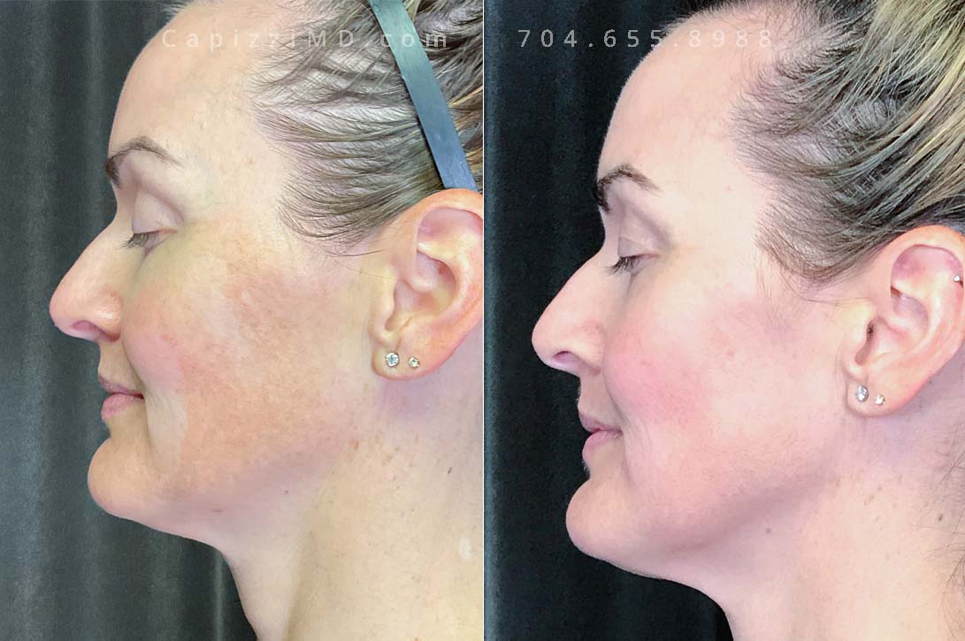 This patient was experiencing melasma that was centered in her lower cheeks, a Cosmelan Peel removed fine lines from her face as well as the hyperpigmentation globally.