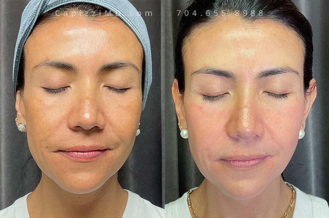 This patient was beginning to experience hormonal pigmentation changes along her cheek bones (bilaterally). A Cosmelan Peel was administered which removed much of that pigmentation and addressed some lighter spots that were beginning to occur around the mouth as well.