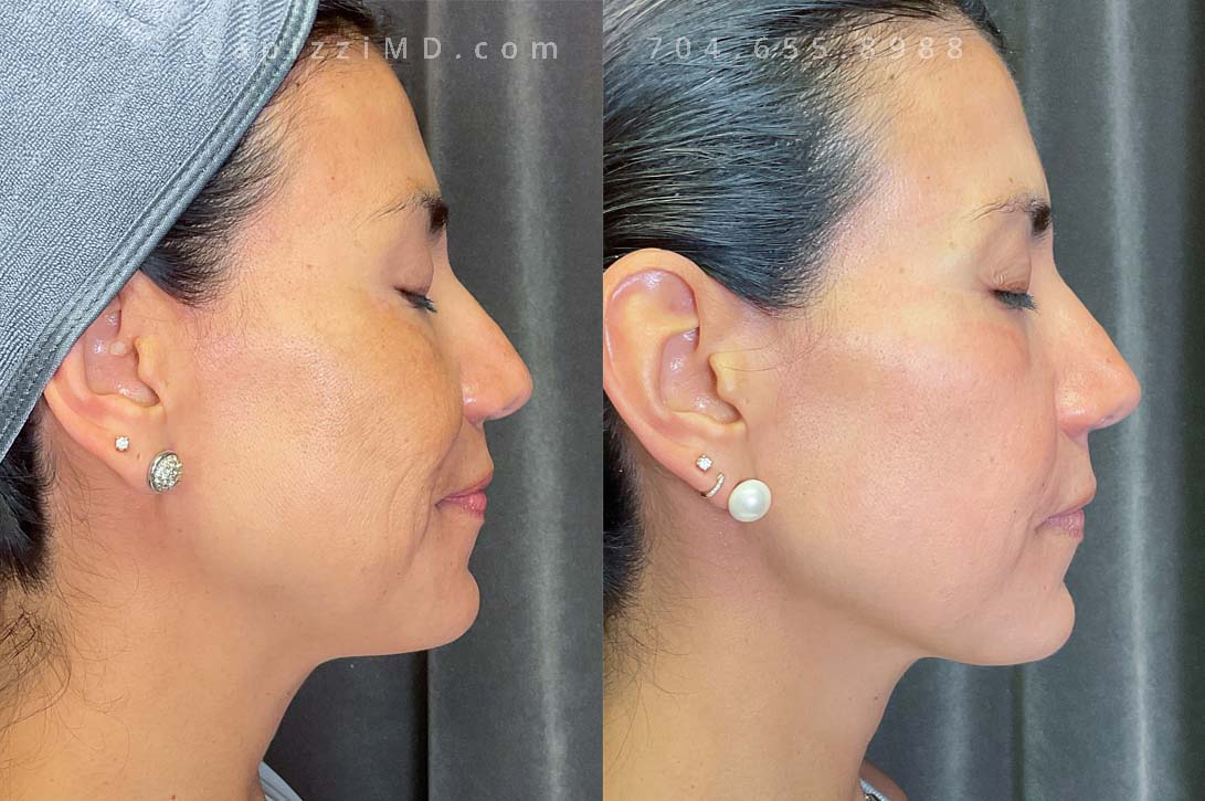 This patient was beginning to experience hormonal pigmentation changes along her cheek bones (bilaterally). A Cosmelan Peel was administered which removed much of that pigmentation and addressed some lighter spots that were beginning to occur around the mouth as well.