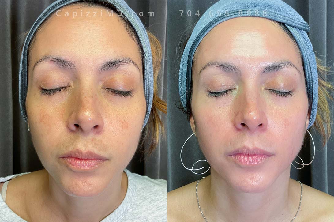 This patient was beginning to experience melasma in her left upper lip as well as pigmentation on her cheeks and chin. A Cosmelan Peel resurfaced the texture of her skin and removed her pigmentation, giving her a fresh glow.