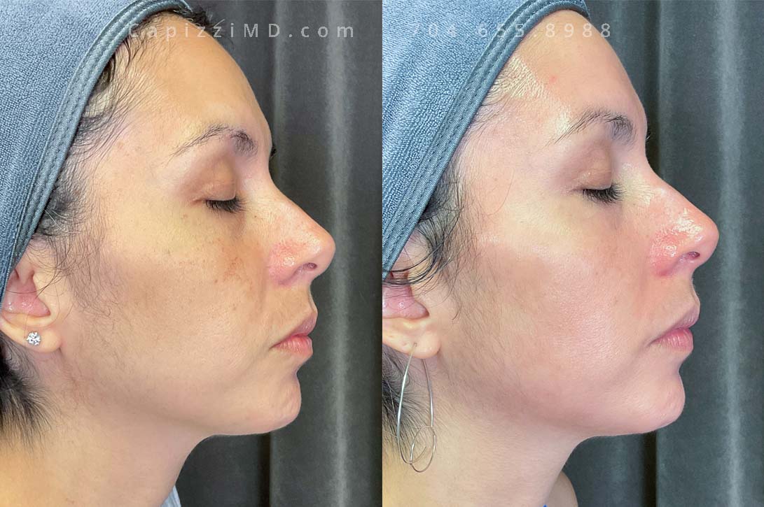 This patient was beginning to experience melasma in her left upper lip as well as pigmentation on her cheeks and chin. A Cosmelan Peel resurfaced the texture of her skin and removed her pigmentation, giving her a fresh glow.