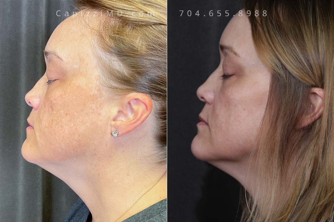 This patient has a complexion that is prone to hyperpigmentation and was experiencing concerns from her cheekbones to chin areas. One Cosmelan Peel was able to address many of her concern areas while refreshing her skin texture and tone.