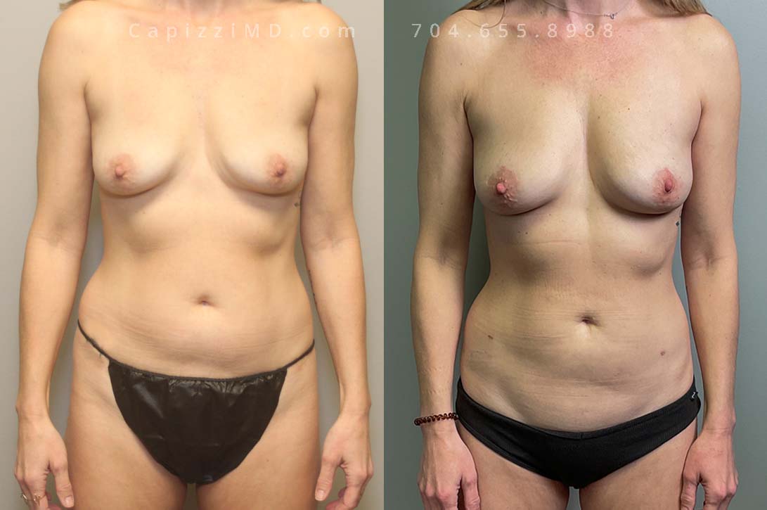 This patient wanted a small amount of upper pole fullness without changing cup sizes.
