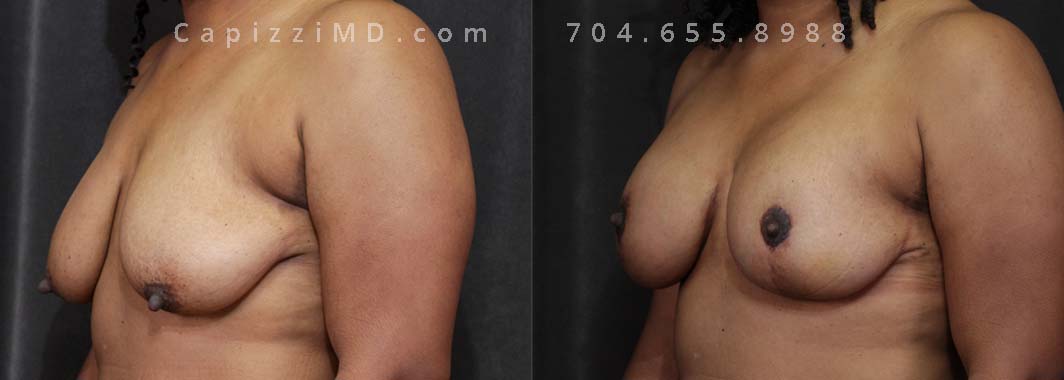 This patient wanted to lift her breasts and return them to their "pre-baby" volume and shape. She had a breast augmentation, full lift, and internal bra placement to align and refine. She also had breast fat grafting to increase her upper pole volume and improve breast contour.