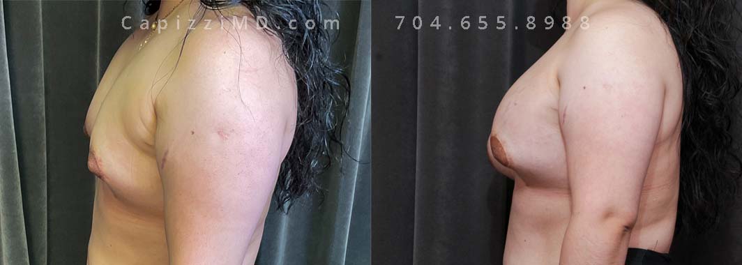 This patient underwent two procedures to get her final result. The reason for a two-stage procedure was the initial size of her breasts limiting how much volume could be added in a single surgery. Her first procedure she received fat grafting to assist in upper pole fullness and to develop a good breast shape. Her second procedure she had an implant placed to achieve a bigger cup size.