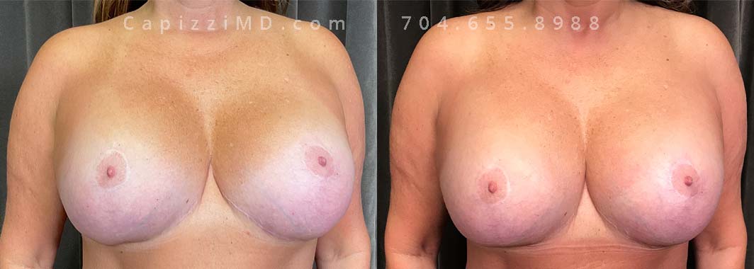 This patient wanted an improvement in the appearance of her older implants, which had undergone visual changes over time. Her Allergan Smooth Round Style SRP 255cc implants were replaced with Sientra Smooth Round High Profile 440cc implants. She also received a capsulectomy (removal) to reposition her pocket and create better symmetry.