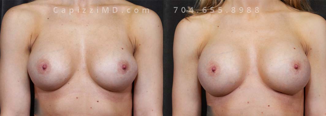 This patient wanted a bigger size and improved symmetry. She had Allergan Smooth Round Style 20 280cc implants and opted to have them replaced with Sientra Smooth Round High Profile 415cc with capsuloraphies to improve the appearance of her breasts.