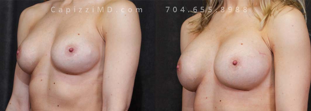 This patient wanted a bigger size and improved symmetry. She had Allergan Smooth Round Style 20 280cc implants and opted to have them replaced with Sientra Smooth Round High Profile 415cc with capsuloraphies to improve the appearance of her breasts.