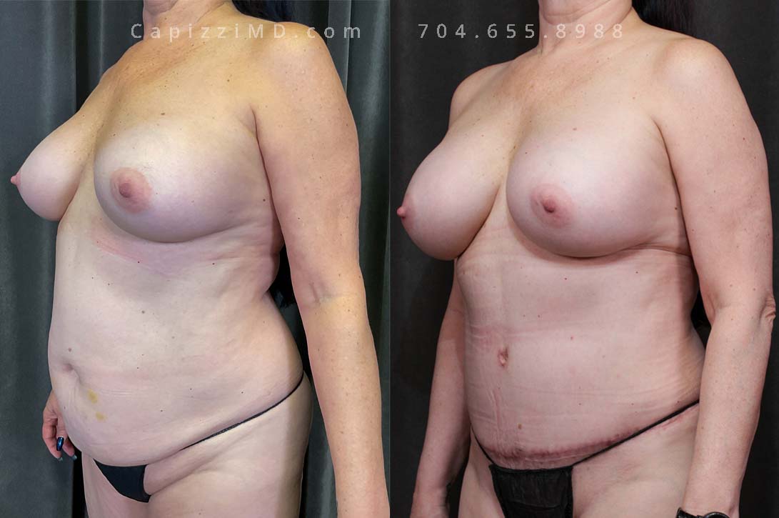 This patient desired an enhanced size and better upper pole fullness. She had her saline 360cc implants replaced with Sientra Smooth Round High Profile 620cc implants for her results.