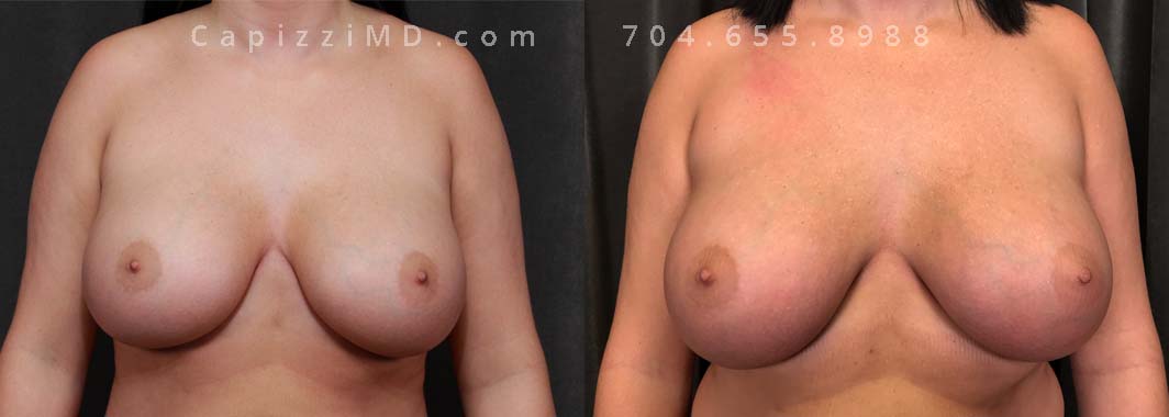 This patient had malpositioned implants and desired a more enhanced look. She had Sientra Smooth Round High Profile 420cc removed and replaced with a Mentor Smooth Round High Profile Saline implant filled to 625cc volume to increase upper pole fullness for a more "fake" look. She also had an internal bra placed to assist the tissue in supporting the larger volume implants and prevent malposition in the future.