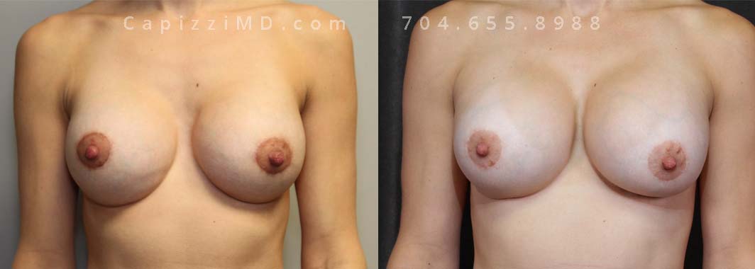 This patient desired a larger breast size and had an implant exchange, going from an Allergan Full Profile 520cc implant to a Mentor Memotyr Gel Smooth Round High Profile 750cc implant. She had internal bra placement as well to assist the tissue in supporting her new larger size.