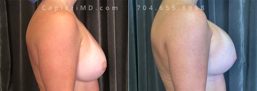 This patient desired an enhanced size and better upper pole fullness. She had her Sientra Smooth Round High Profile 470cc implants replaced with Sientra Textured Round High Profile 650cc implants for her results.