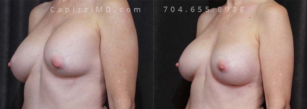The patient experienced a right side deflation of her saline implant and a capsular contracture in her left breast as well. Both implants were removed, including removal of her left capsule to relieve the contracture, and replaced with Sientra Smooth Round High Profile 330cc implants.