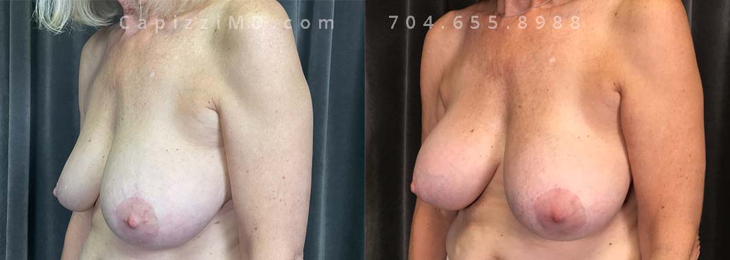 This patient experienced a right side deflation/rupture of her saline implant. Her implants were exchanged for Sientra Smooth Round High Profile 280cc implants for improved symmetry and appearance.