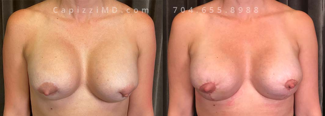 This patient experienced a right side rupture of her silicone implant. Her implants were exchanged for Sientra Smooth Round High Profile 285cc implants along with a modified breast lift for improved symmetry and appearance.