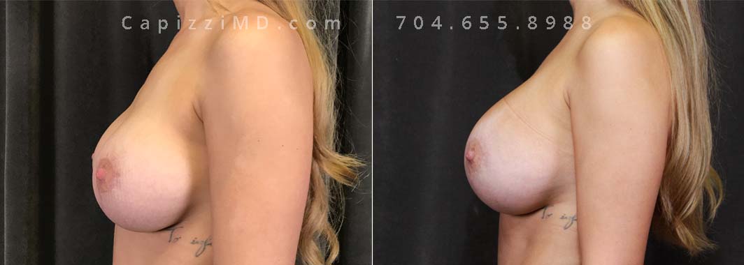 This patient desired a larger breast size and had an implant exchange, going from a Sientra Smooth Round High Profile 350cc implant to a Sientra Textured Round High Profile 590cc implant. She had capsule work done as well to improve symmetry.