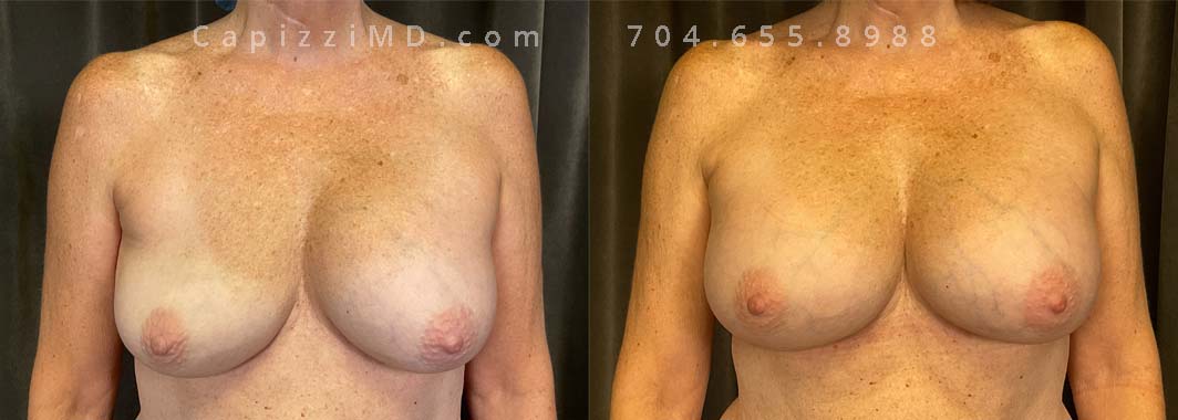 This patient experienced a right side deflation/rupture of her saline implant. Her implants were exchanged for Sientra Textured Round High Profile 330cc implants for improved symmetry and appearance.