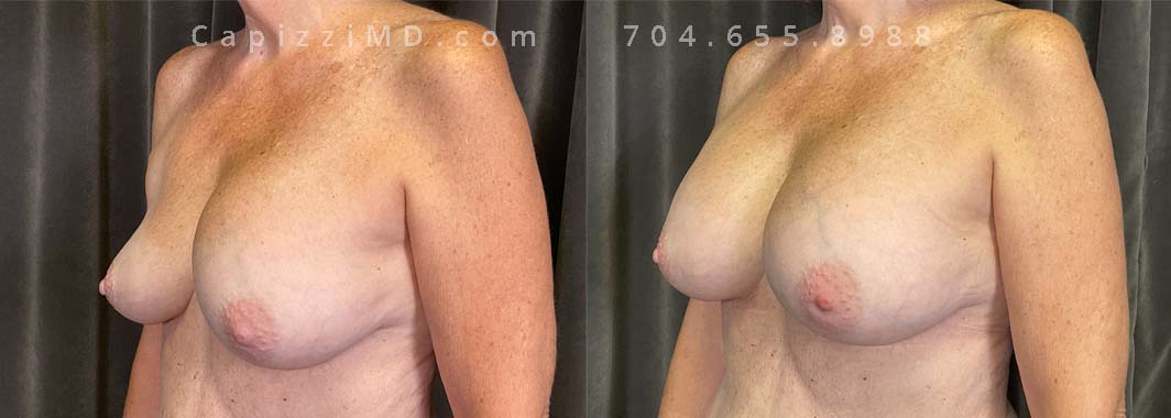 This patient experienced a right side deflation/rupture of her saline implant. Her implants were exchanged for Sientra Textured Round High Profile 330cc implants for improved symmetry and appearance.