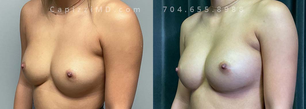 This patient desired an enhanced size and better upper pole fullness. She had her Allergan Smooth Round Style 15 286cc implants replaced with Sientra Smooth Round High Profile 385cc implants for her results.