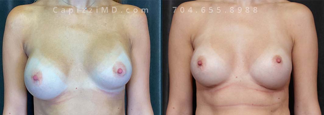 This patient was experiencing a capsular contracture of the left breast, which was remedied by a bilateral exchange and internal bra placement to assist in providing support to the new implants.