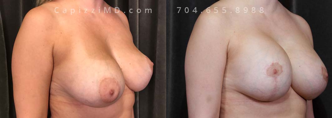 This patient was experiencing asymmetry and her left breast was "bottoming out." Her Allergan Smooth Round Saline 320cc implants were removed and replaced with Sientra Textured Round High Profile 565cc implants to achieve better upper pole fullness and a larger appearance.