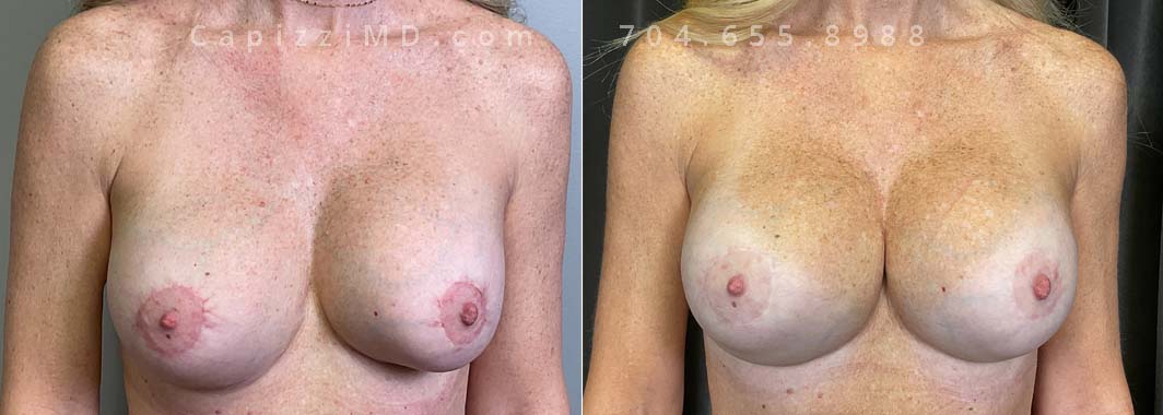 This patient desired an enhanced size and better upper pole fullness. She had her Sientra Smooth Round High Profile 505cc implants replaced with Sientra Smooth Round High Profile 620cc implants and an internal bra for her results.