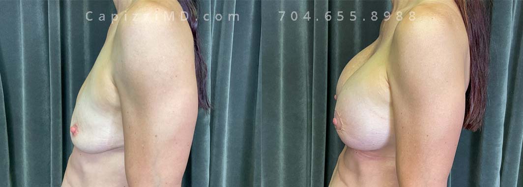 This patient had deflation after having children and received a Breast Augmentation with Mini Lift and Internal Bra placement. Sientra Smooth Round HP 470cc implants.