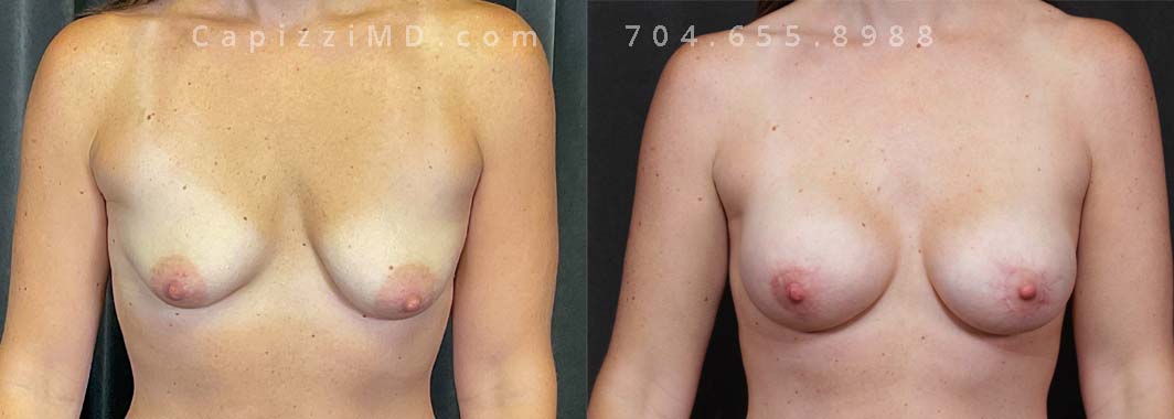 This patient had deflation and mild asymmetry after having children. A breast augmentation with mini lift restored her pre-baby breasts! Sientra Smooth Round HP 330cc implants.