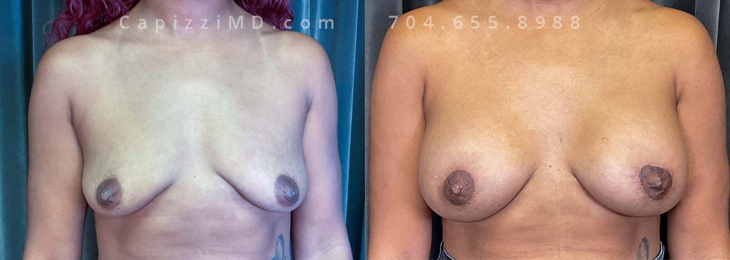 This patient wanted to restore volume and lift in her breasts. A breast augmentation with Benelli lift helped her achieve her goals. Sientra Smooth Round HP 415cc implants.