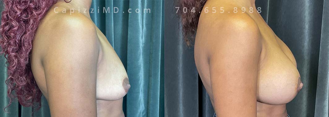 This patient wanted to restore volume and lift in her breasts. A breast augmentation with Benelli lift helped her achieve her goals. Sientra Smooth Round HP 415cc implants.