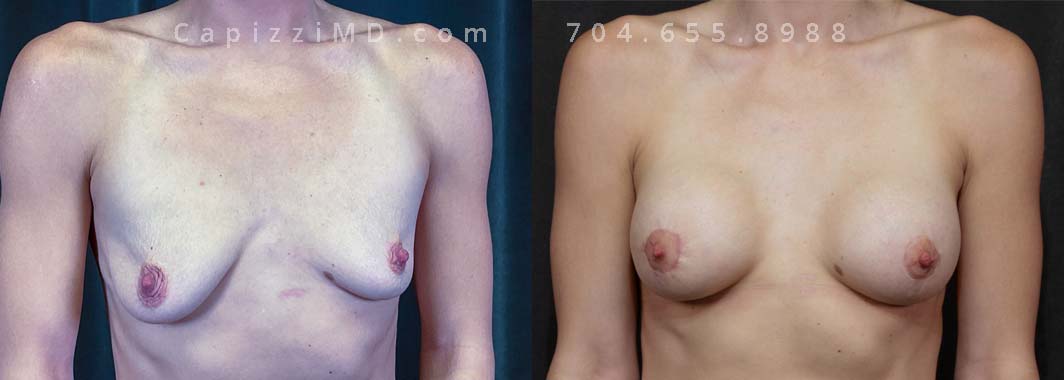 Implants enhanced her volume, while a mini breast lift subtly repositioned her nipples for a perkier look. The 440cc Sientra Smooth Round HP implants provided the desired fullness, while the mini breast lift addressed the positioning of the nipples, creating a more youthful and balanced appearance.