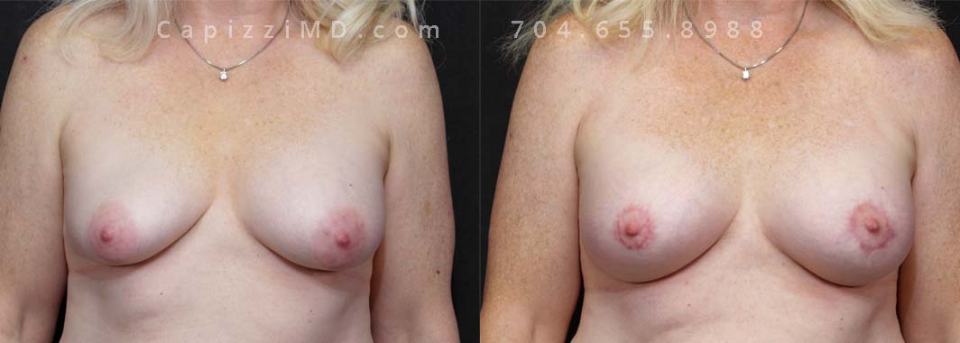 Longing for a lift and some added lift? This patient's dream of naturally fuller breasts came true thanks to two procedures: smooth, round 350cc Sientra implants for volume and a discreet mini breast lift to perk things up.