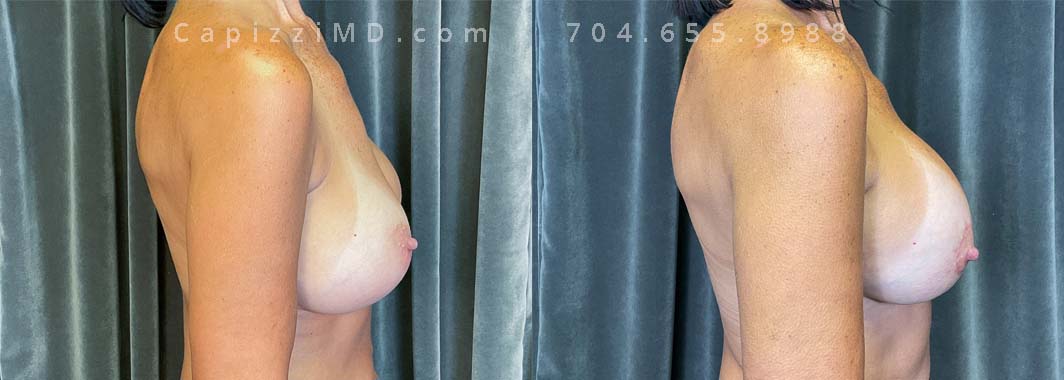 This patient wanted to fix displacement of her existing implants and restore her upper pole volume. She made the switch from saline implants to Sientra Smooth Round HP 415cc gummy bear implants with a mini lift and internal bra placement.