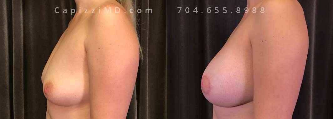 This patient wanted natural-appearing larger breasts. A breast augmentation achieved her volume desires while a mini breast lift realigned her nipples. Sientra Smooth Round HP 440cc implants.
