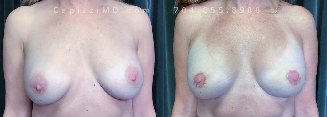 "Longing for fuller breasts that still whispered "natural," she found her perfect solution. We replaced her old saline implants with Sientra Smooth Round HP 565cc gummy bear implants to gift her the volume she craved, while a mini lift subtly nudged things north, restoring a perky, youthful look. She is 2 weeks post-op in her after photos, you will still be able to see the healing of her incisions and light bruising.