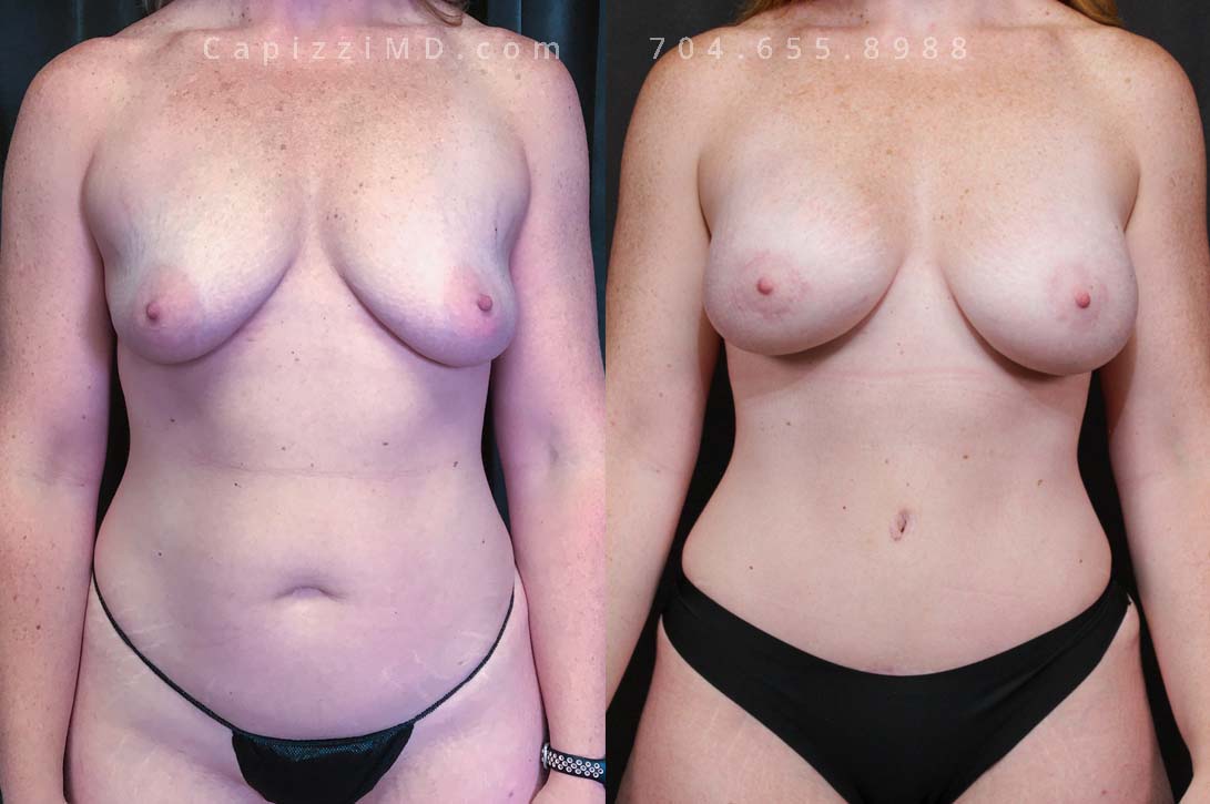 This patient wanted a mommy makeover after having children. Her goals were achieved with a Breast Augmentation, Mini Breast Lift, Tummy Tuck, and liposuction to her posterior hips. Sientra Textured Round HP 470cc implants.