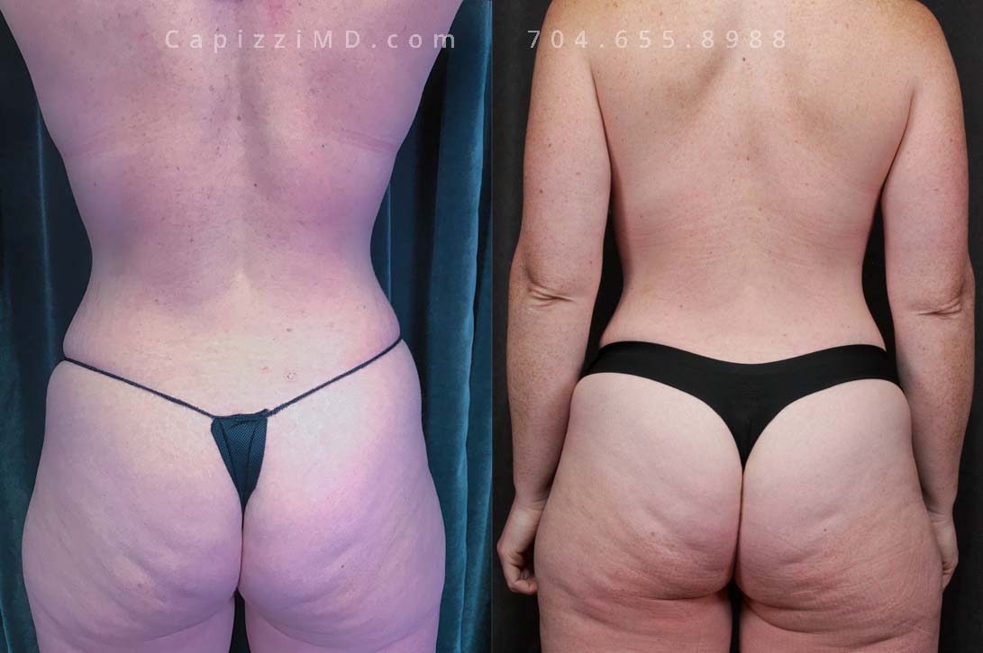 This patient wanted a mommy makeover after having children. Her goals were achieved with a Breast Augmentation, Mini Breast Lift, Tummy Tuck, and liposuction to her posterior hips. Sientra Textured Round HP 470cc implants.