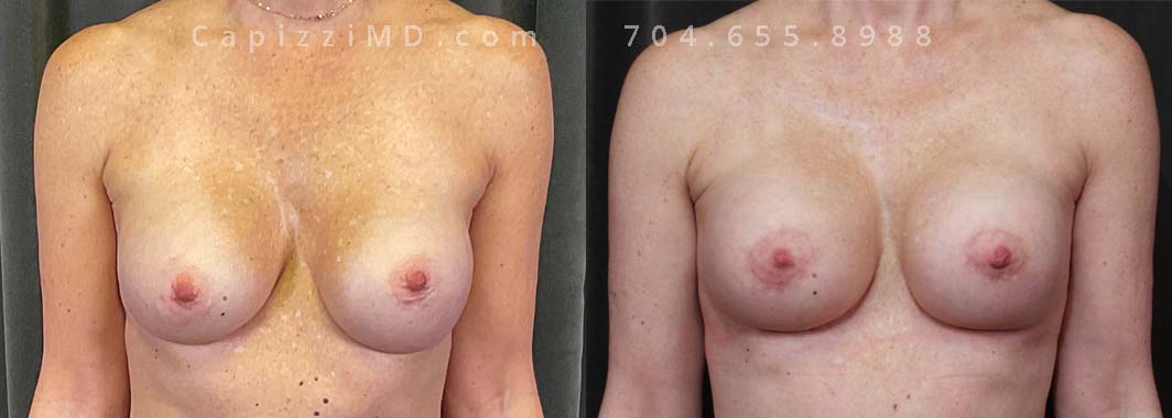 This patient desired a natural-looking fill and a boost for her breasts. So, she traded her saline implants for Sientra Smooth Round HP 385cc and 415cc gummy bear implants. She also received a mini lift and internal bra placement to help keep their placement.