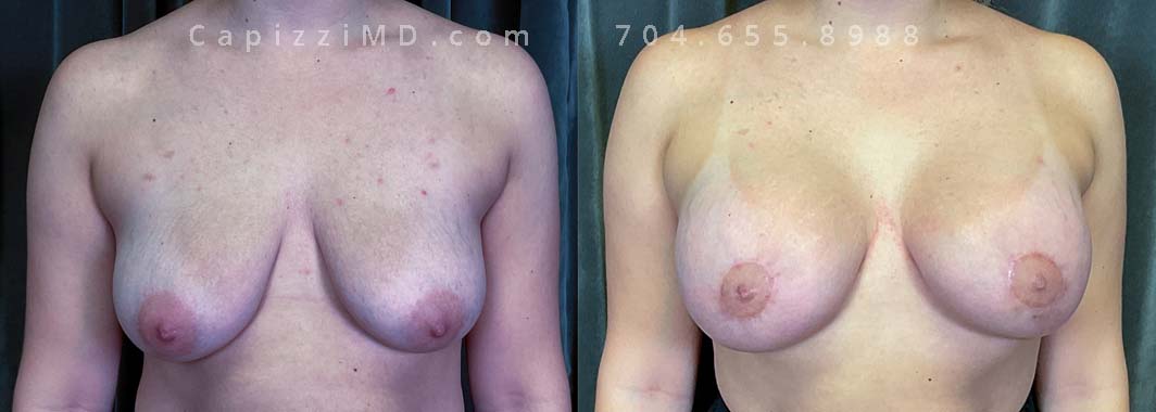 This patient wanted to increase her upper pole volume and lift. She received a mini/Benelli lift with breast augmentation. Sientra Smooth Round HP 470cc implants.