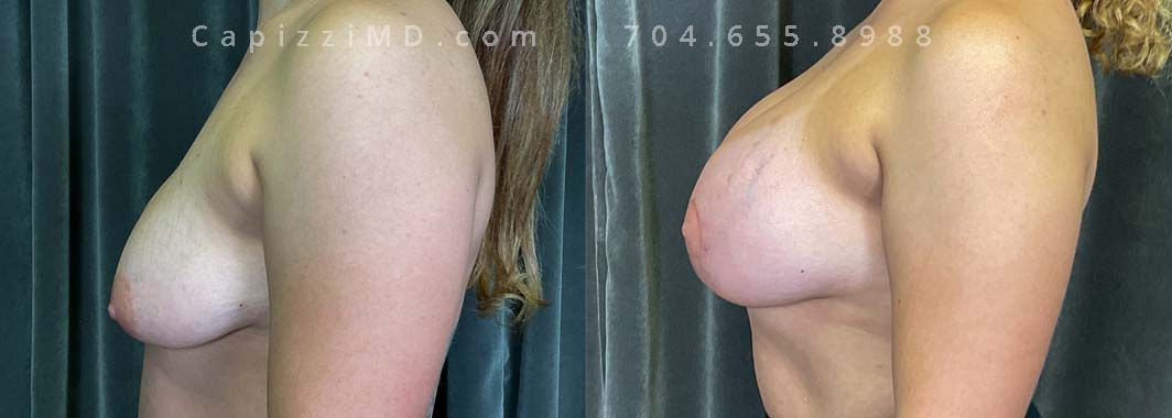 This patient wanted to increase her upper pole volume and lift. She received a mini/Benelli lift with breast augmentation. Sientra Smooth Round HP 470cc implants.