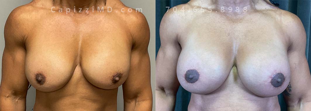 This patient was experiencing tightening in the left breast which ended up being an intracapsular rupture of her Mentor Smooth MP 500cc silicone implant. She wanted a larger look with volume in the upper pole. She received an implant exchange and mini breast lift with Sientra Smooth Round HP 620cc implants.